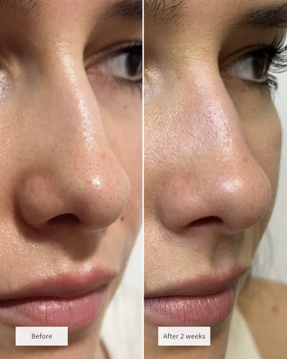 Hydrocolloid Pore Patch Nose Patch Cleans Pores