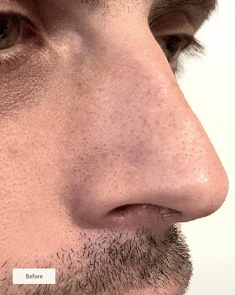Hydrocolloid Pore Patch Nose Patch Cleans Pores